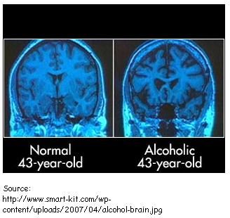 alcoholic brain