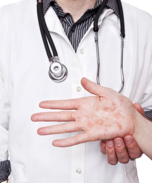 eczema in hand photo
