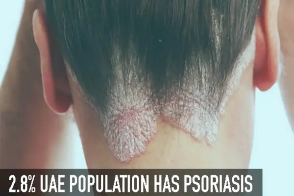 Silvery scaly patches seen in Psoriasis Scalp psoriasis at the hairline with text: “2.8% UAE population has psoriasis”