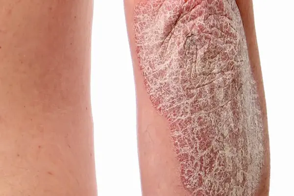 Close-up of plaque on a leg with thick, scaly, inflamed skin