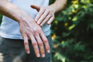 Hand with Psoriasis NAET Dubai