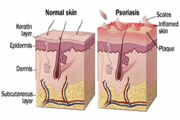 Diagram comparing normal skin vs psoriasis showing inflamed plaques and scaling