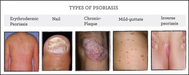 Types of psoriasis chart showing plaque, guttate, inverse, nail, and erythrodermic psoriasis