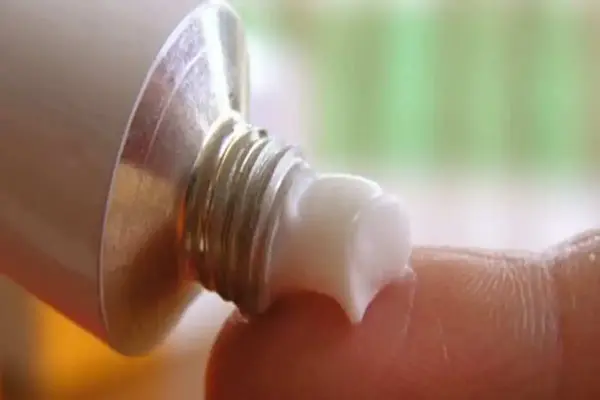 Topical cream being applied—common symptom relief for psoriasis flare-ups