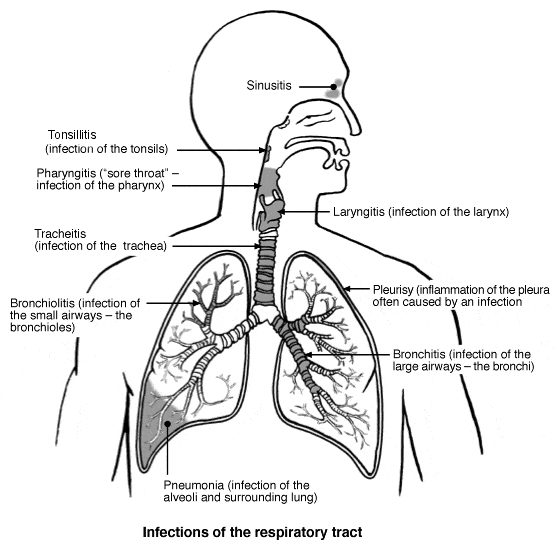 Acute Bronchitis NAET Dubai