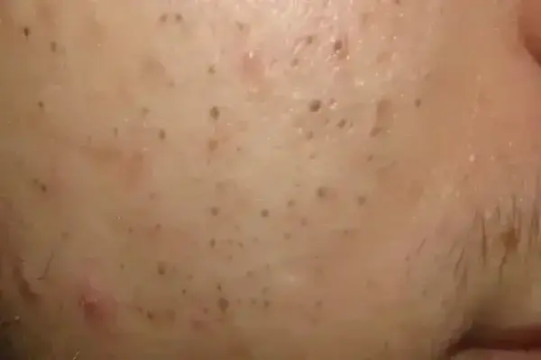 Close-up of blackheads and clogged pores on facial skin