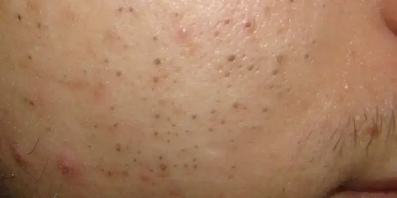 Blackheads on the nose treated with natural acne treatment for clearer skin without harsh chemicals.