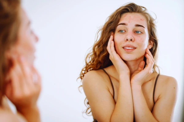 Young woman looking in the mirror with acne—low self-esteem and self-consciousness