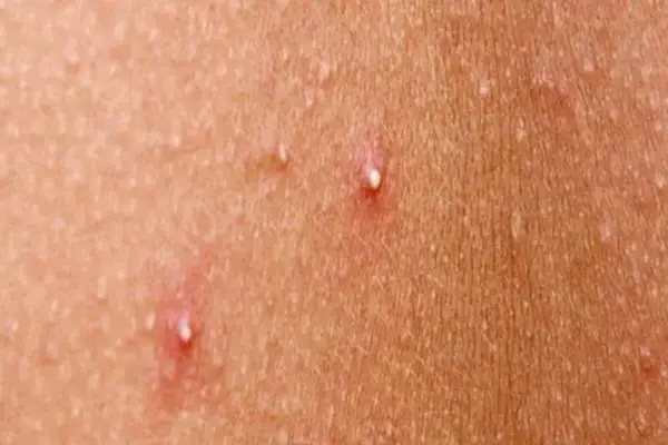 Close-up of whiteheads—small bumps from clogged pores