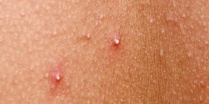 Whiteheads on the cheek caused by clogged pores and excess oil—addressed through natural acne treatment targeting root acne causes.