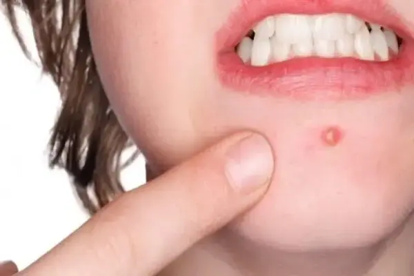 Pustule pimple on the chin—white pus-filled acne bump with redness