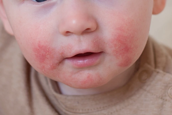Baby with red, dry, irritated cheeks typical of infant atopic dermatitis