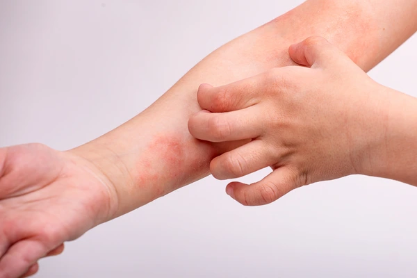 A child scratching a red rash on the forearm from dermatitis itching