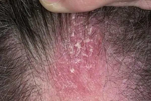 Flaky, red scalp patch consistent with seborrheic dermatitis