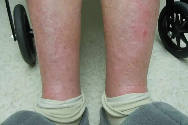 Swollen, red lower legs with dry, scaly skin typical of stasis dermatitis