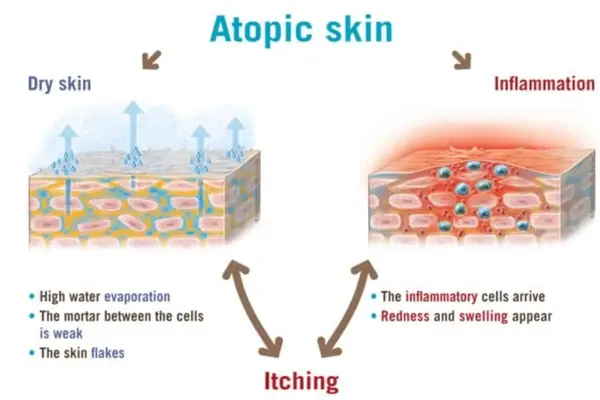 Diagram showing atopic dermatitis cycle with dry skin, inflammation, and itching