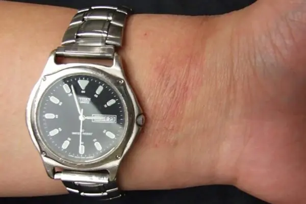 Red rash under a wristwatch band, consistent with nickel contact dermatitis