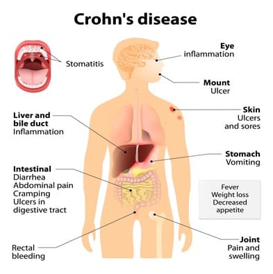 Crohn's Disease NAET Dubai