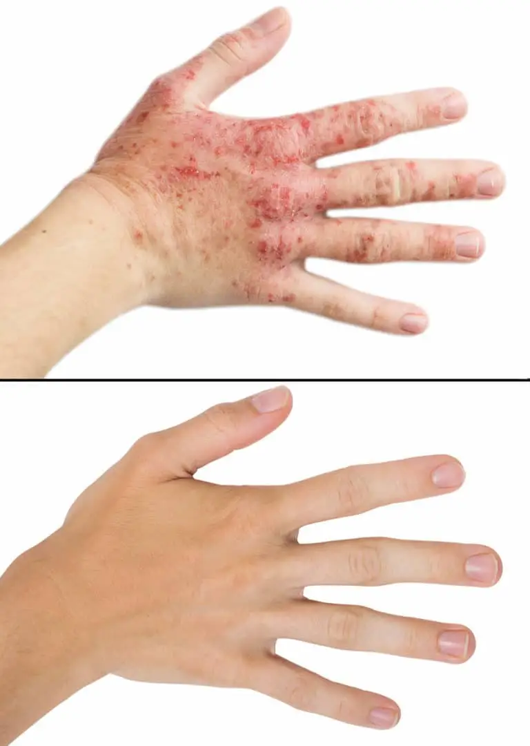 eczema, before and after