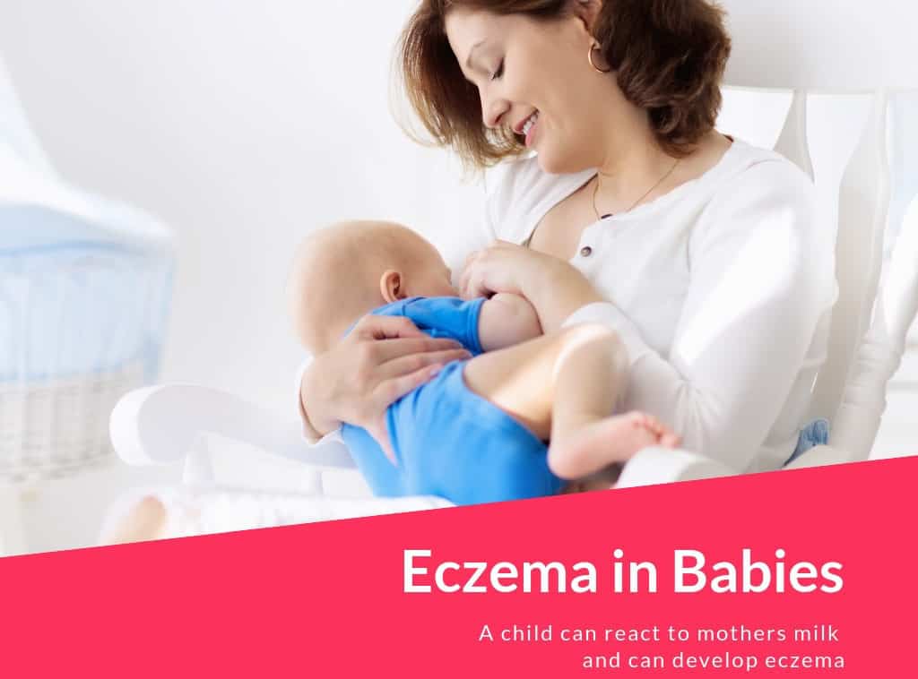 Eczema in Babies 