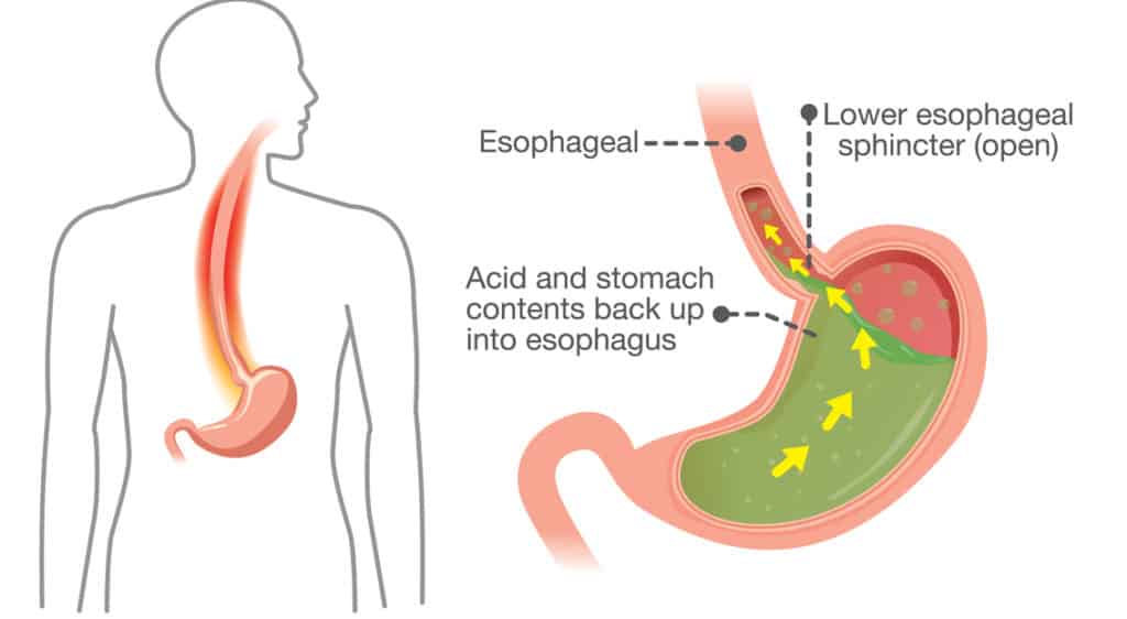 Complication with Esophagitis 