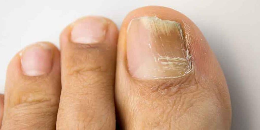 Candida Infection in Nail