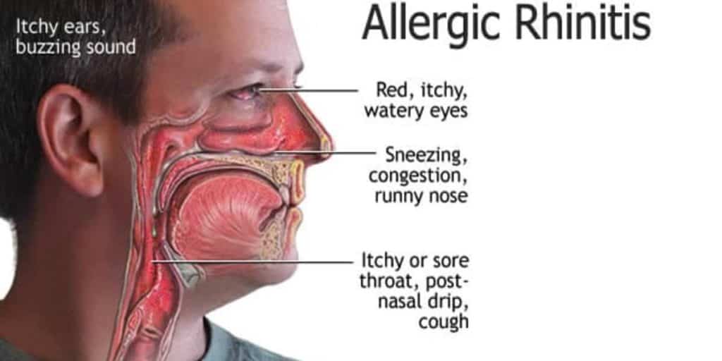 Allergic rhinitis symptoms
