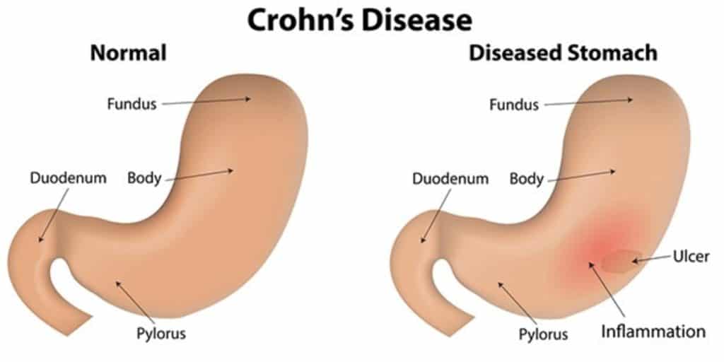 Crohn's Disease
