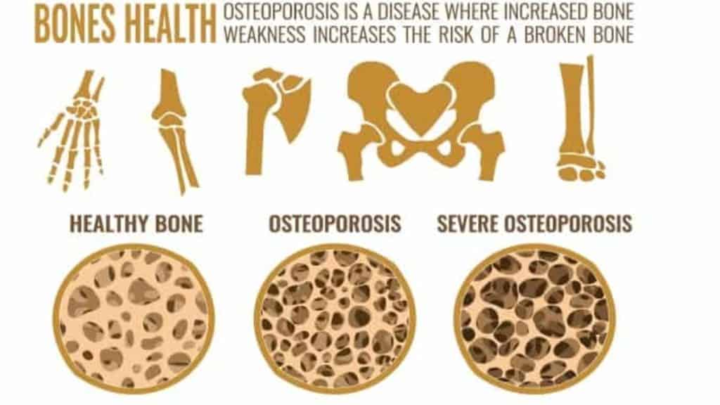 Osteoporosis / Complications