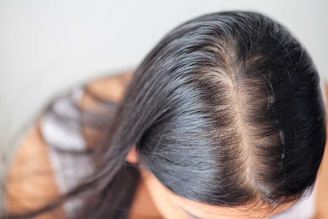 telogen effluviu hair loss dubai