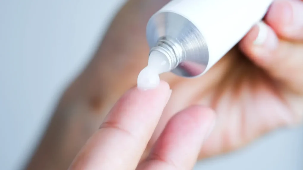 Hand squeezing a topical steroid cream onto a fingertip for an skin flare up