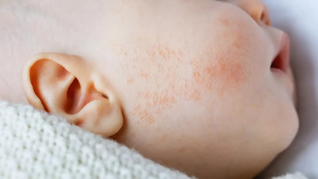 Baby’s cheek with red, dry rash—baby eczema flare-up