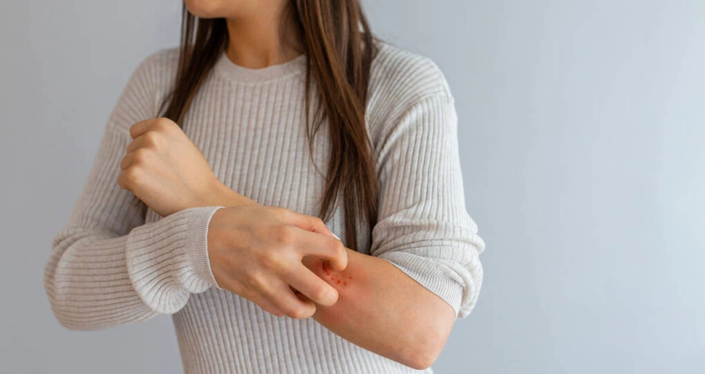 Woman scratching an itchy rash on her forearm during an eczema flare-up