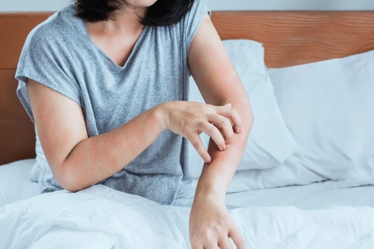 Woman scratching an itchy, red patch on her forearm during an eczema flare-up