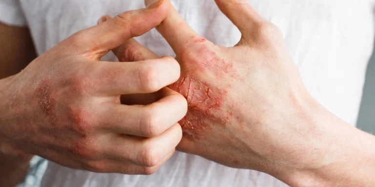 Hands with eczema showing red, itchy, cracked skin and inflammation