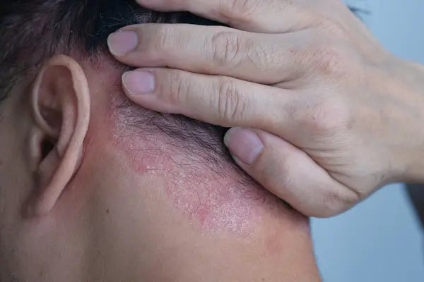 Red, dry rash on the back of the neck near the hairline, consistent with eczema