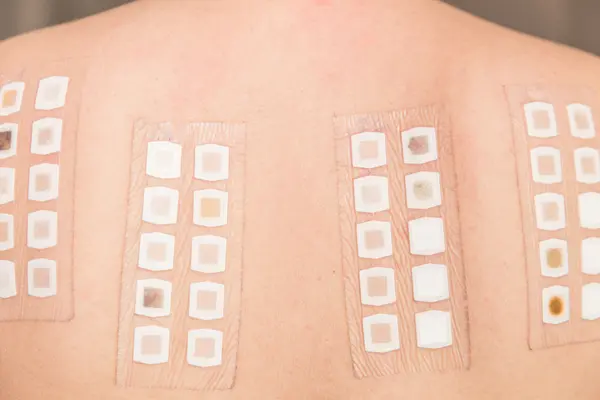 Allergy patch test strips on skin to identify triggers linked to eczema flare-ups