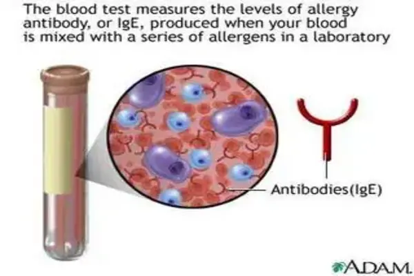 Diagram of IgE blood testing used to measure allergy antibodies linked to eczema triggers