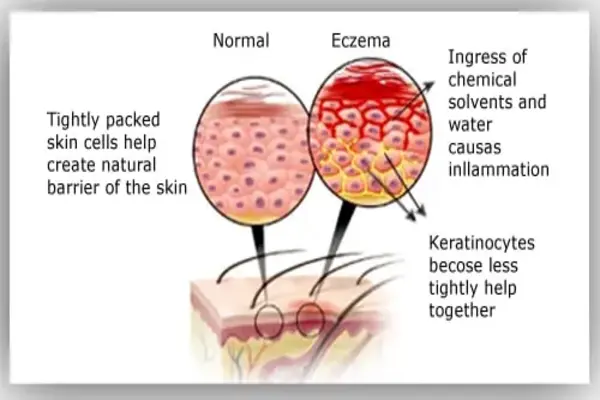 Diagram comparing normal skin barrier with eczema-affected skin showing inflammation