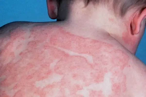 Child’s back with widespread red eczema rash and inflammation